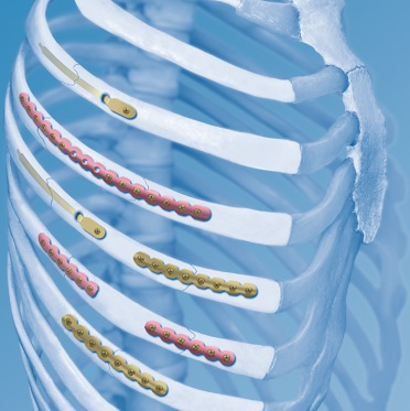 The MatrixRIB Fixation System from DePuy Synthes